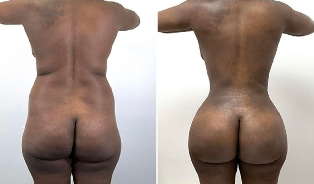 Curvify Hip Booster Injection